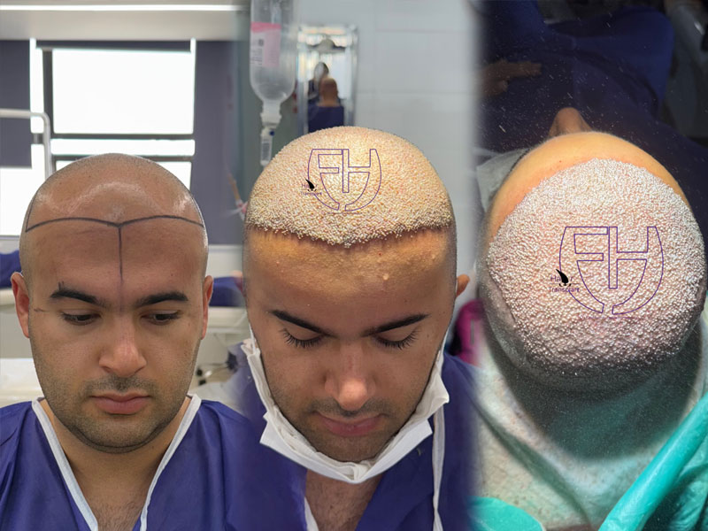 کاشت مو به روش fit و sut