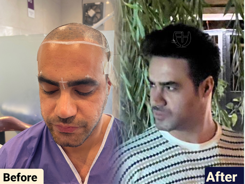 کاشت مو به روش fit و sut