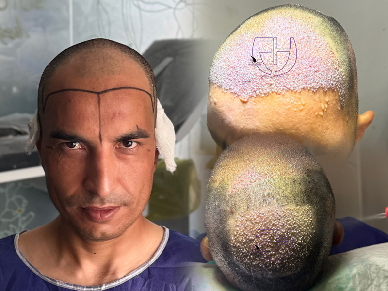 کاشت مو به روش fit و sut