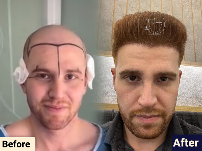 کاشت مو به روش fit و sut