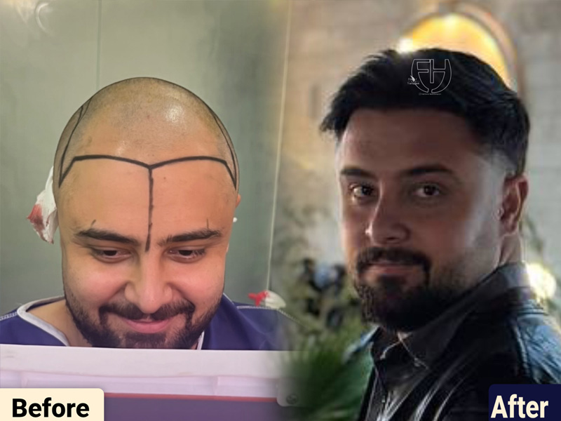 کاشت مو به روش fit