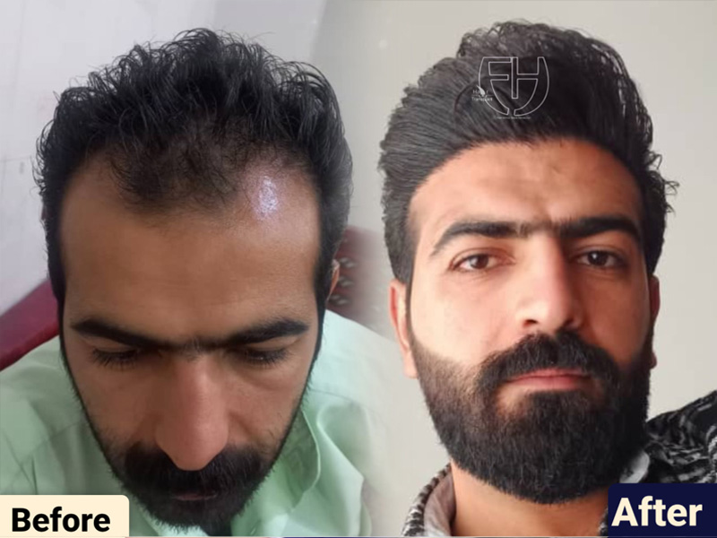 کاشت مو به روش fit