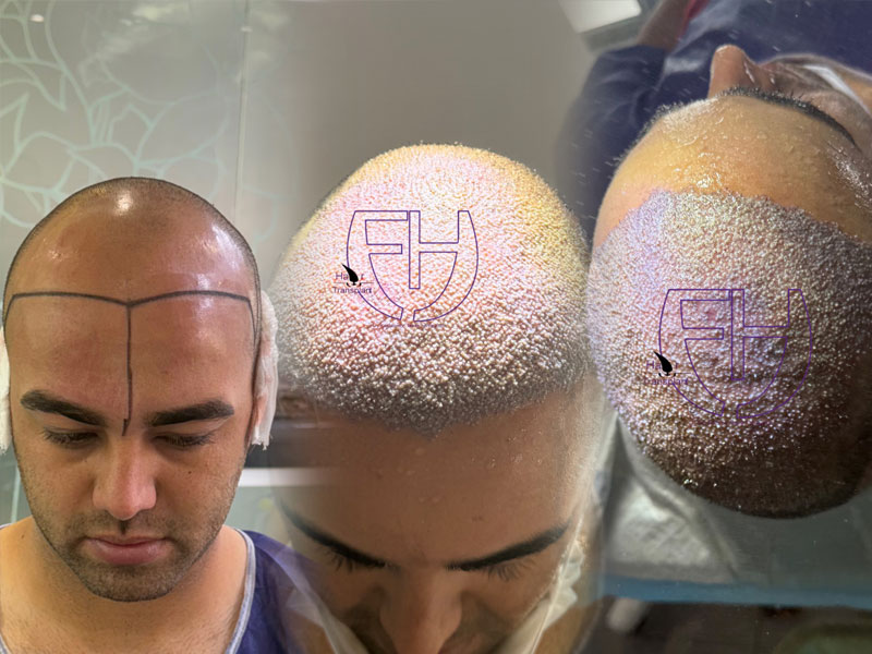 کاشت مو به روش fit