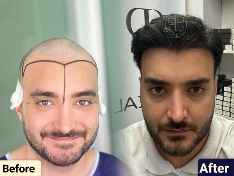 کاشت مو به روش fit