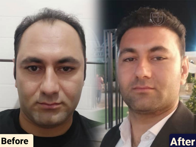 کاشت مو به روش fit و sut