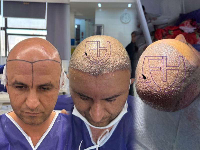 کاشت مو به روش fit