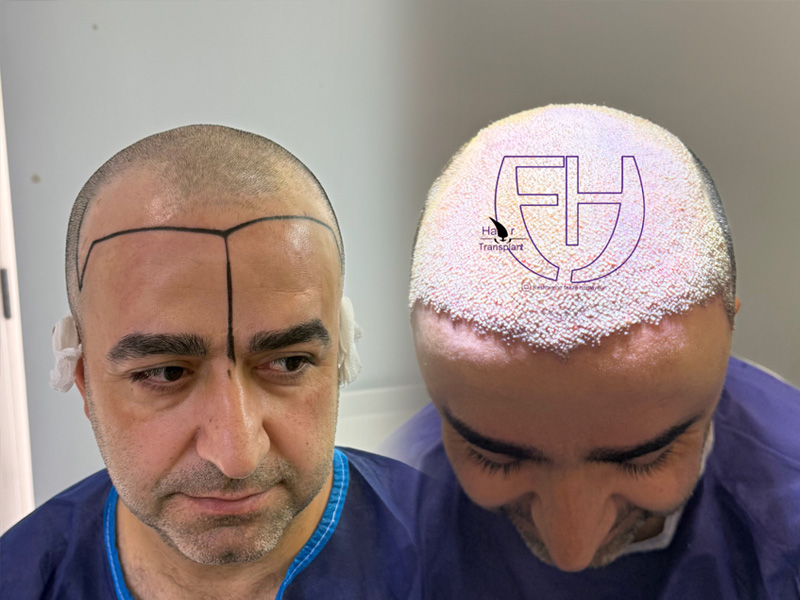 کاشت مو به روش fit