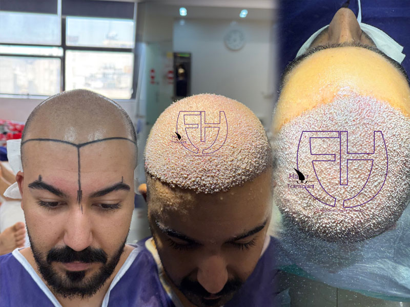 کاشت مو به روش fit و sut