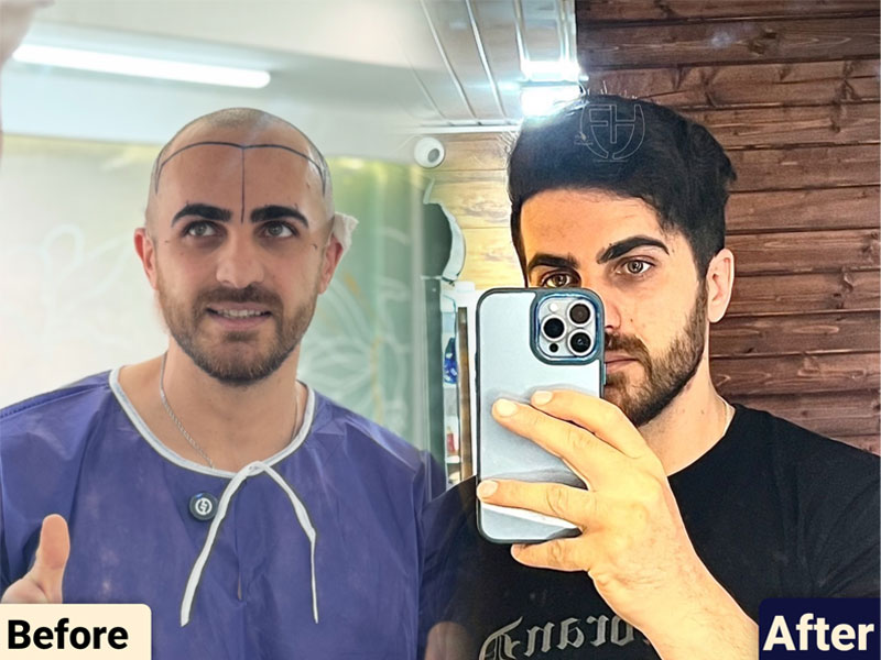 کاشت مو به روش fit