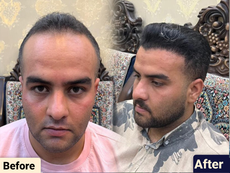 کاشت مو به روش fit