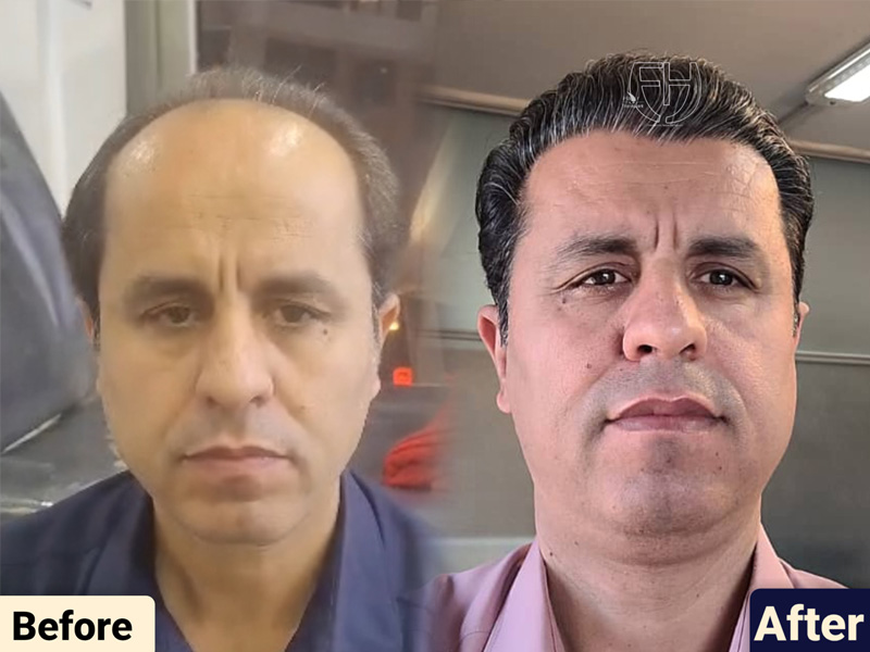 کاشت مو به روش fit