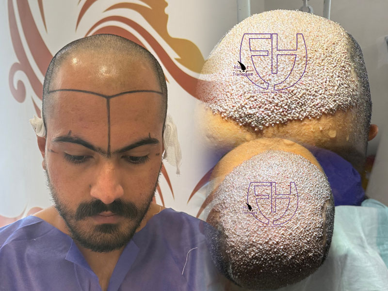 کاشت مو به روش fit