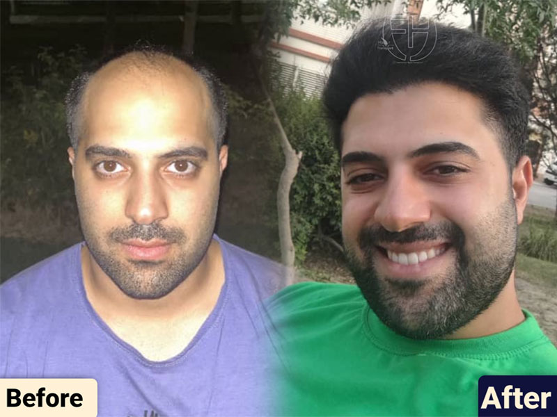 کاشت مو به روش fit