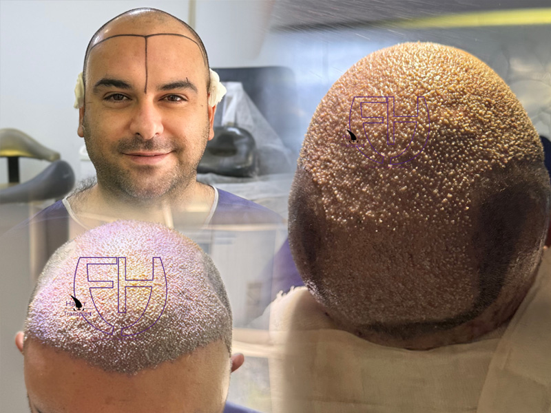 کاشت مو به روش fit