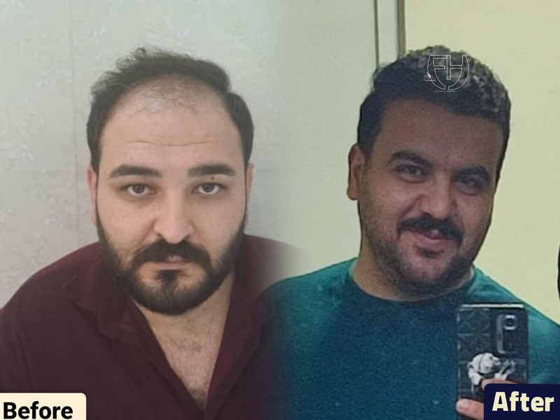 کاشت مو به روش fit و sut