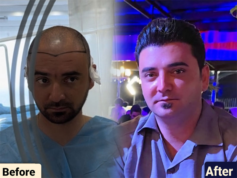 کاشت مو به روش fit