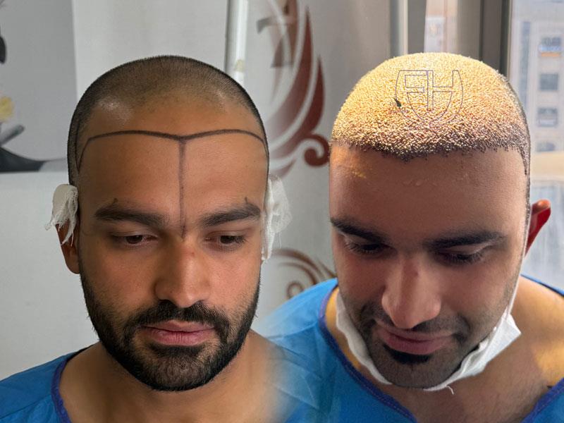 آیا کاشت مو دائمی است؟ بررسی ماندگاری نتایج کاشت مو