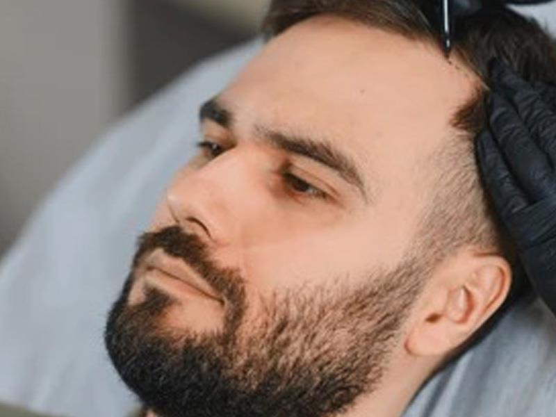 آیا کاشت مو برای همه افراد مناسب است؟