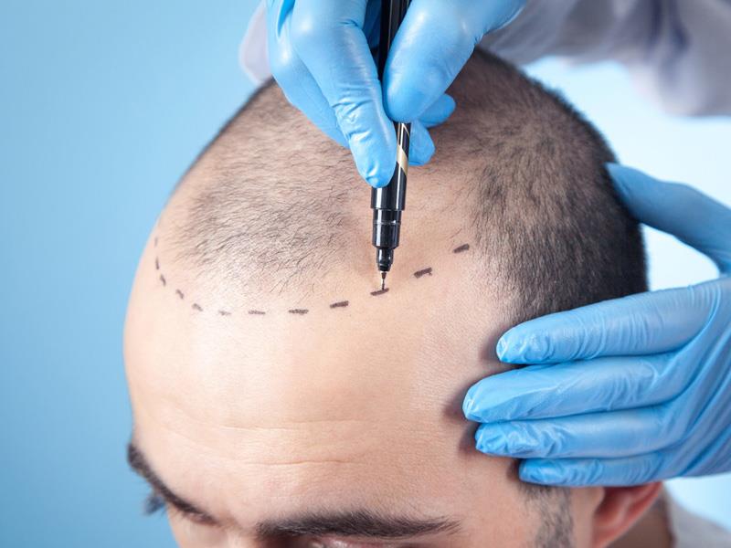 کاشت مو به روش FIT در شیراز کاشت مو تخصصی همایون